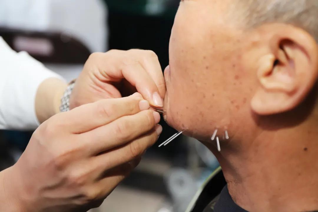 全省首推颊针疗法！长春市妇产医院麻醉疼痛门诊开诊