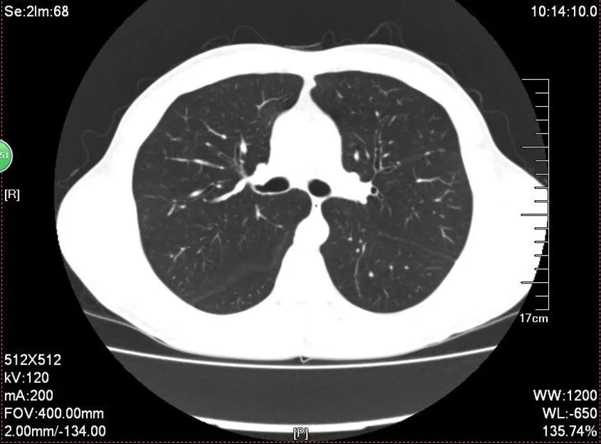 嗜酸性粒细胞高咳嗽,咳嗽嗜酸性粒细胞高是什么原因