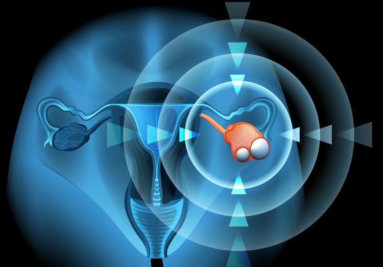 介入栓塞治疗巧克力囊肿,介入超声治巧克力囊肿需要多久