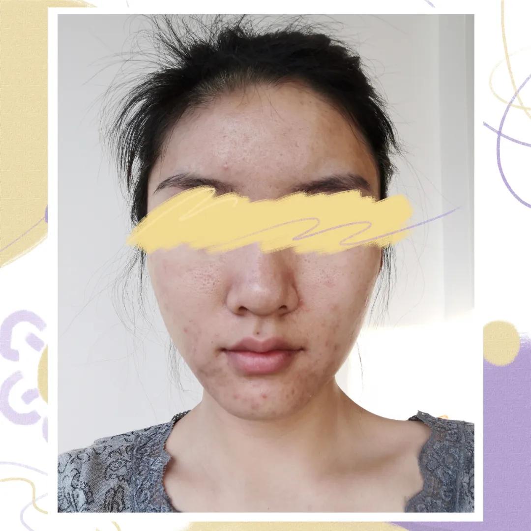 大痘印适合做什么医美,医美做什么可以去除痘坑