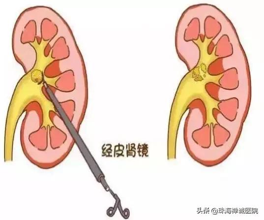 碎石方法有哪些,体外碎石取石视频全过程