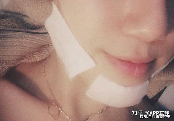 脸刷酸可以祛痘印吗,祛痘印刷什么酸