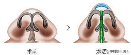 鼻头缩小后鼻孔里增生了,鼻头鼻翼缩小疤痕增生怎么办