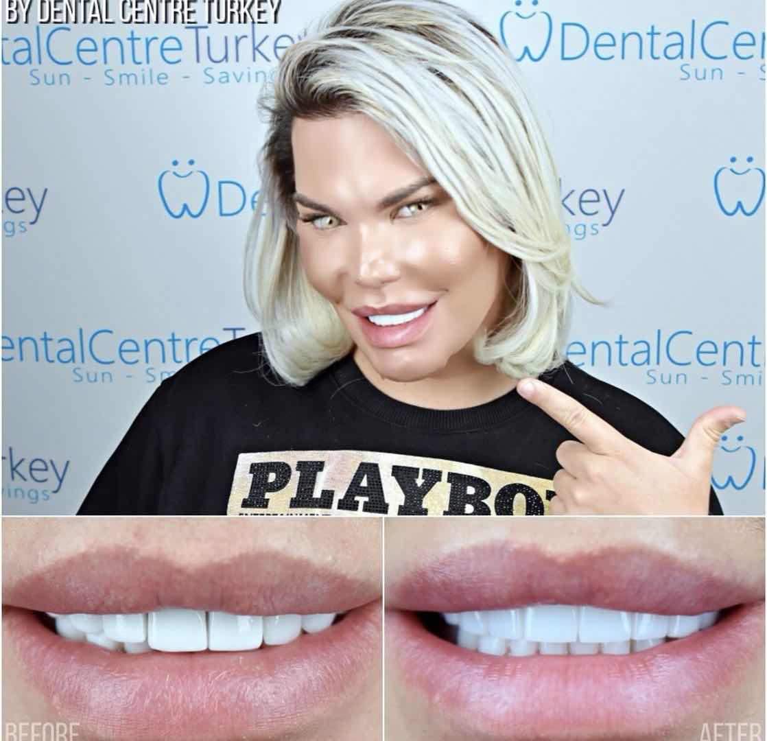 巴西男整容42次图片,巴西男模花数百万整容