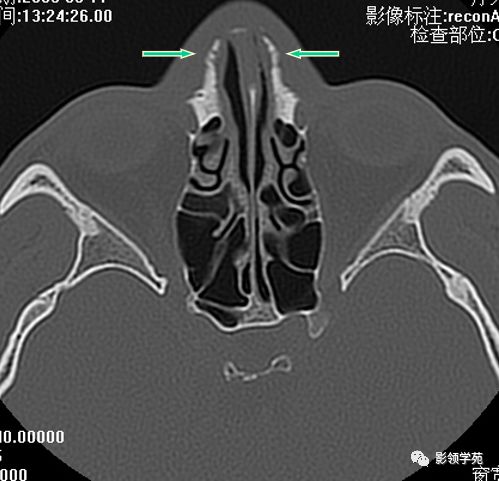 鼻骨骨折的检查方法,鼻骨骨折影像学表现