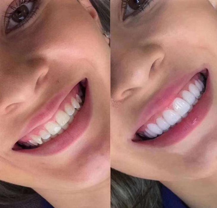 揭露欧美明星牙齿美白的秘密,牙齿美白最好的方法大黄牙