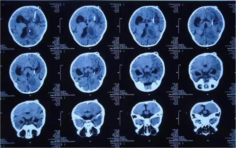 孩子脑积水反复发烧,婴儿脑积水引起发烧如何保守治疗