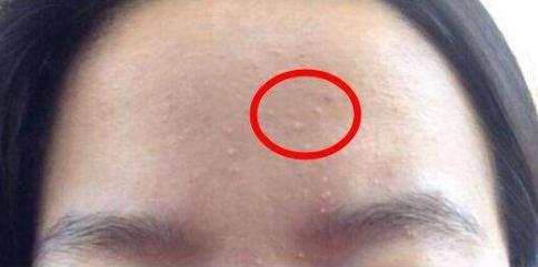 脸上有小米粒怎么消除摸起来刺痒,脸上的小米粒怎么去除小妙招