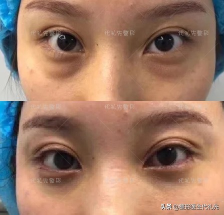 问一下有什么方法快速消除眼袋,关于眼袋的去除方法