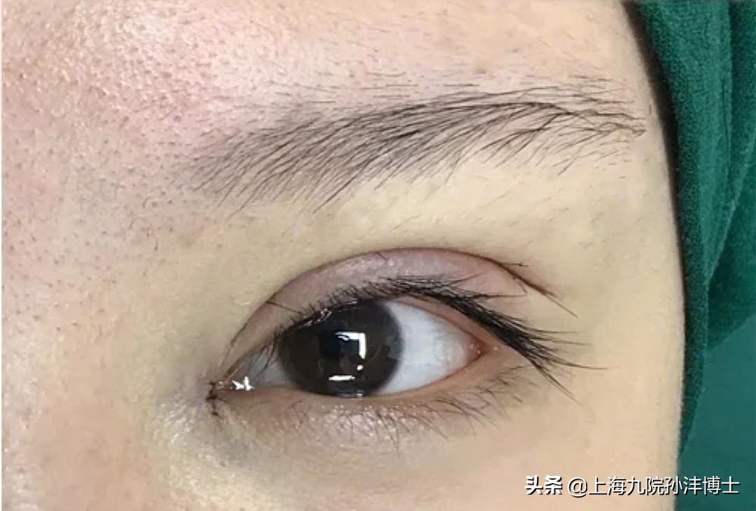 修复双眼皮眼角有分叉怎么办,双眼皮修复折痕分叉