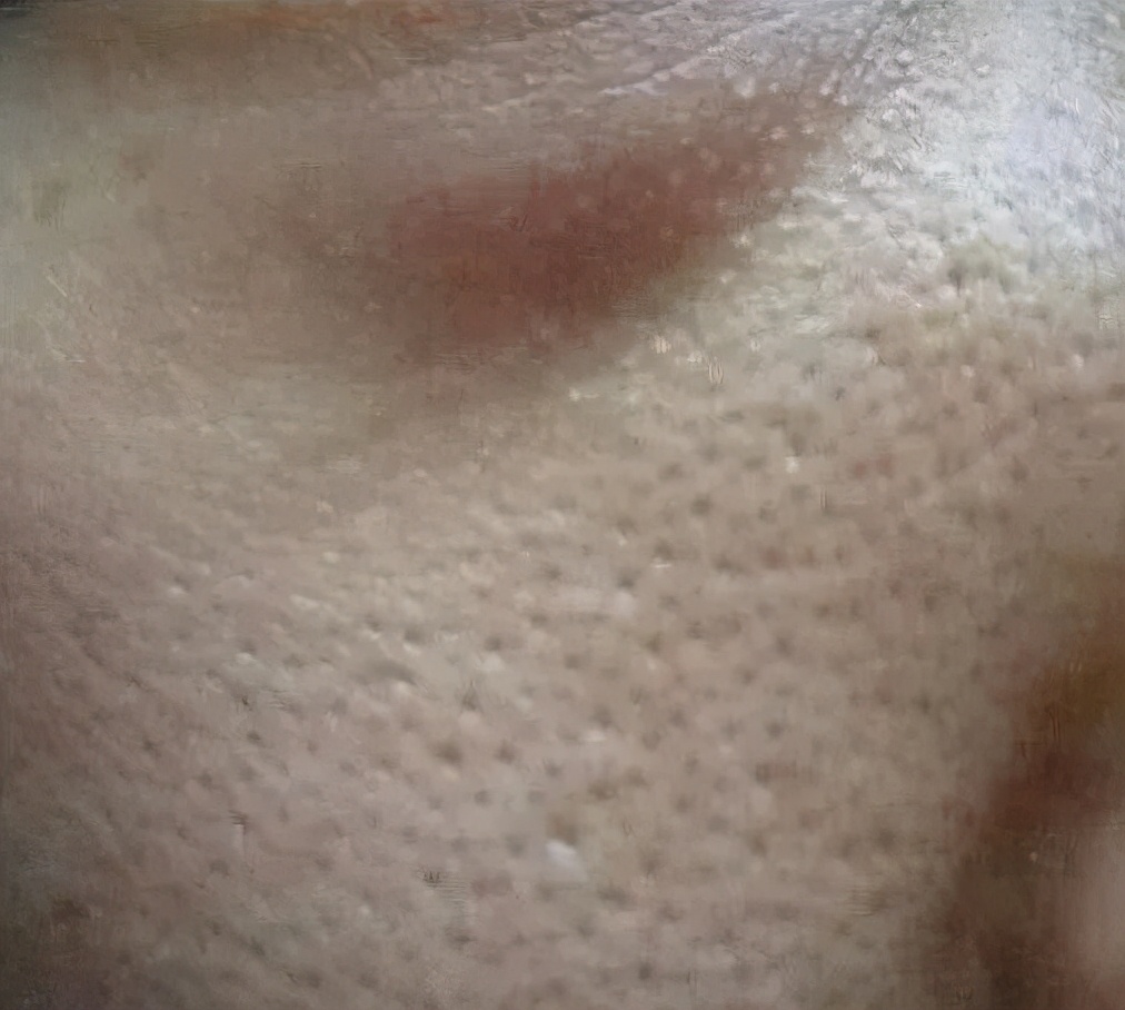 解决毛孔粗大最有效的方法,毛孔粗大有黑头喝中药调理可以吗