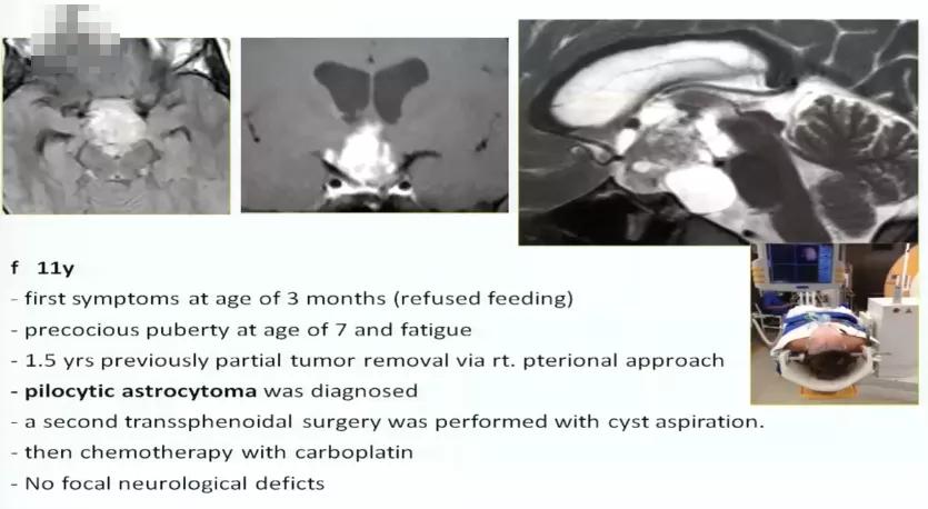 INC巴特朗菲教授视频|视神经-下丘脑胶质瘤全切案例集及治疗解读