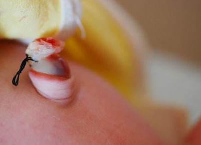 出生20天宝宝肚脐出血是怎么回事,新生儿脐带脱落后肚脐出血的护理