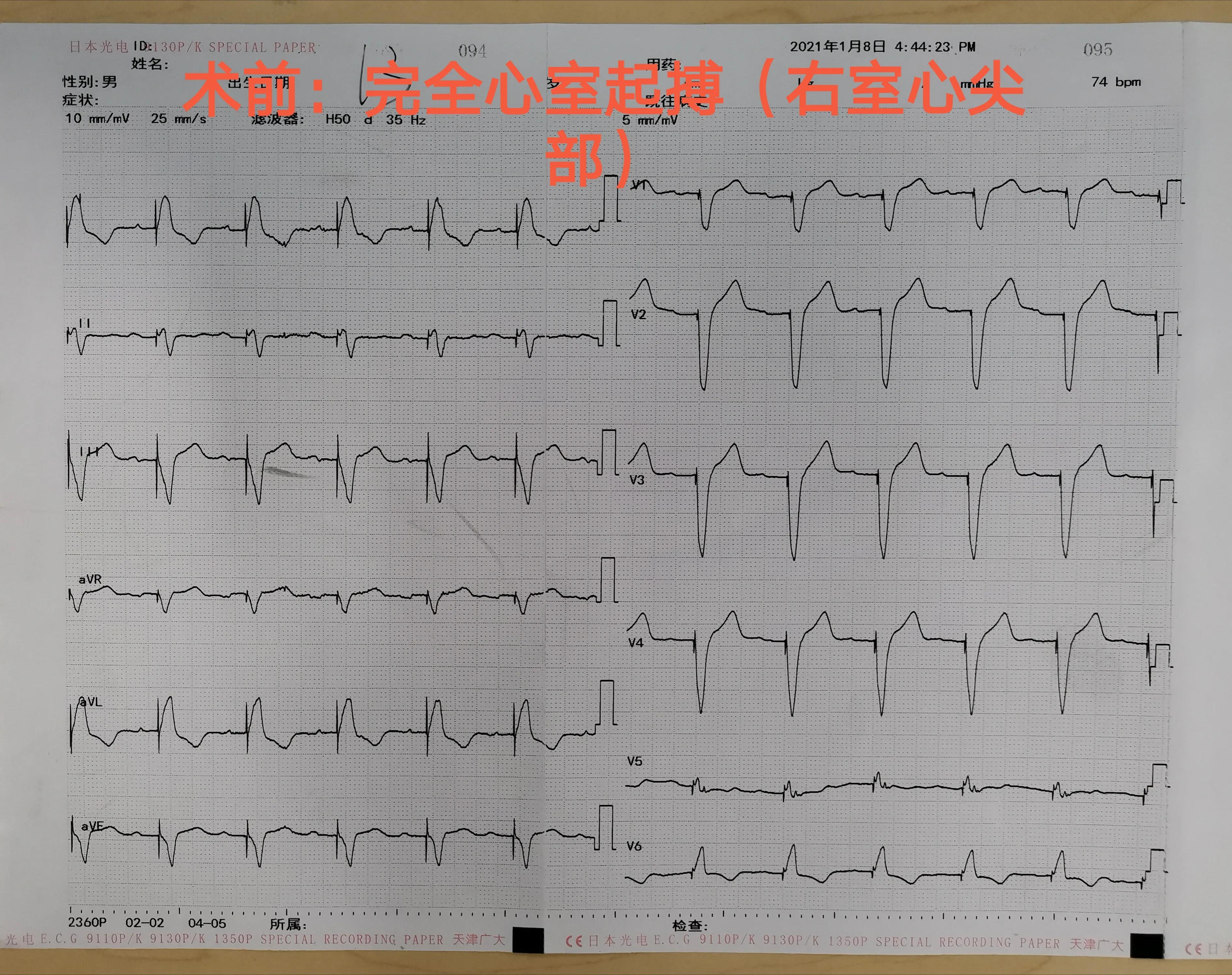 88岁老人心跳过快需要装起搏器吗,老人胸闷气短找中医看可以吗