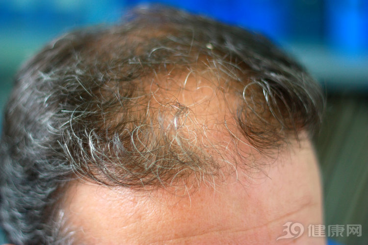 脱发产品辟谣,生发膏辟谣