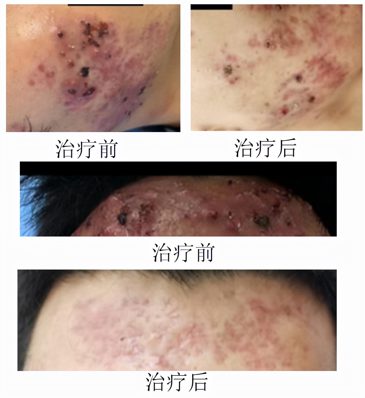 怎么拯救痘痘脸,治疗脸上痘痘最好最有效的方案