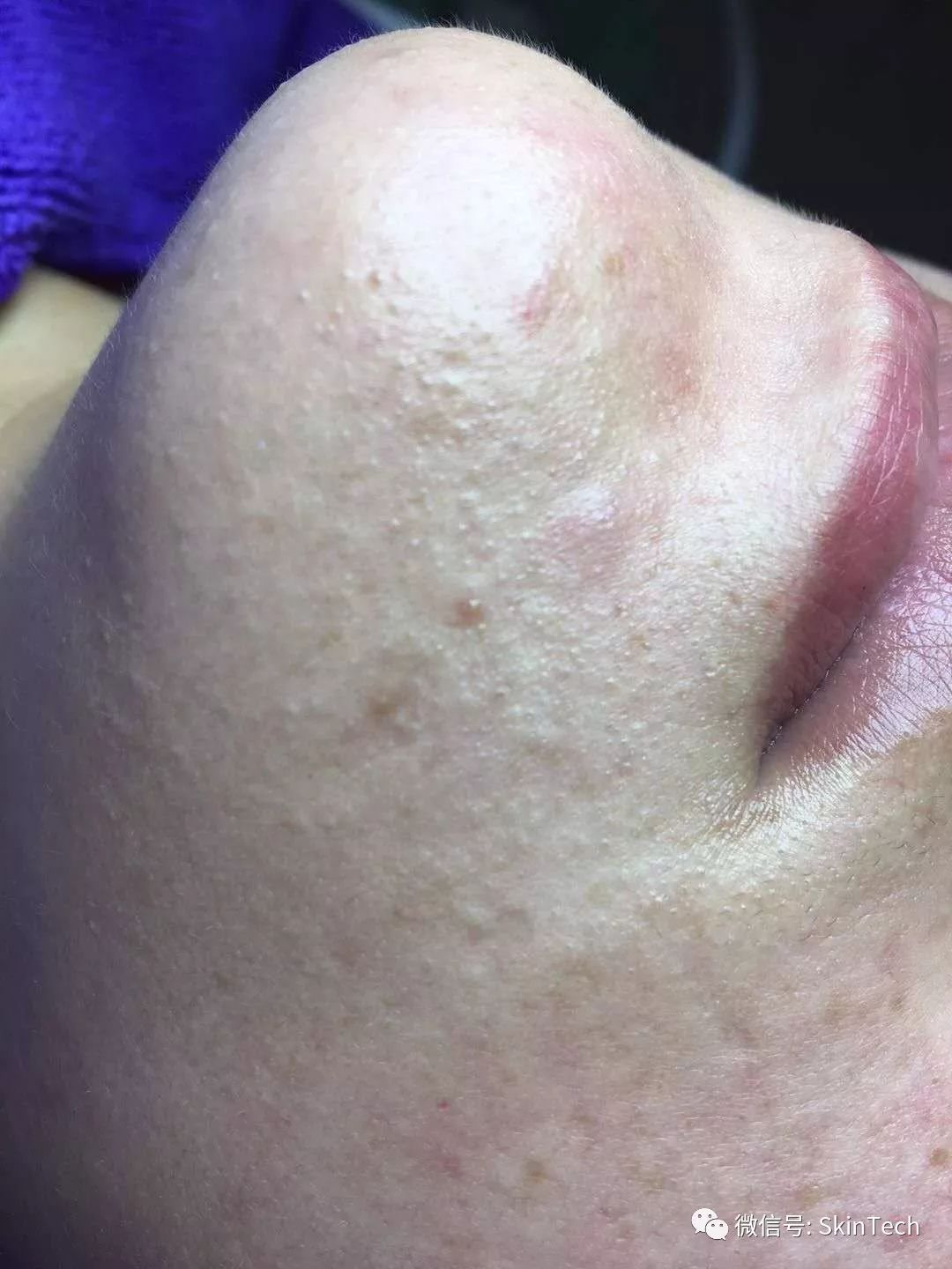 逆光疹是属于皮肤炎症吗,逆光疹是不是日光性皮炎