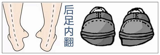 孩子足外翻与足内翻怎么办呢,足内翻和足外翻按摩什么穴位