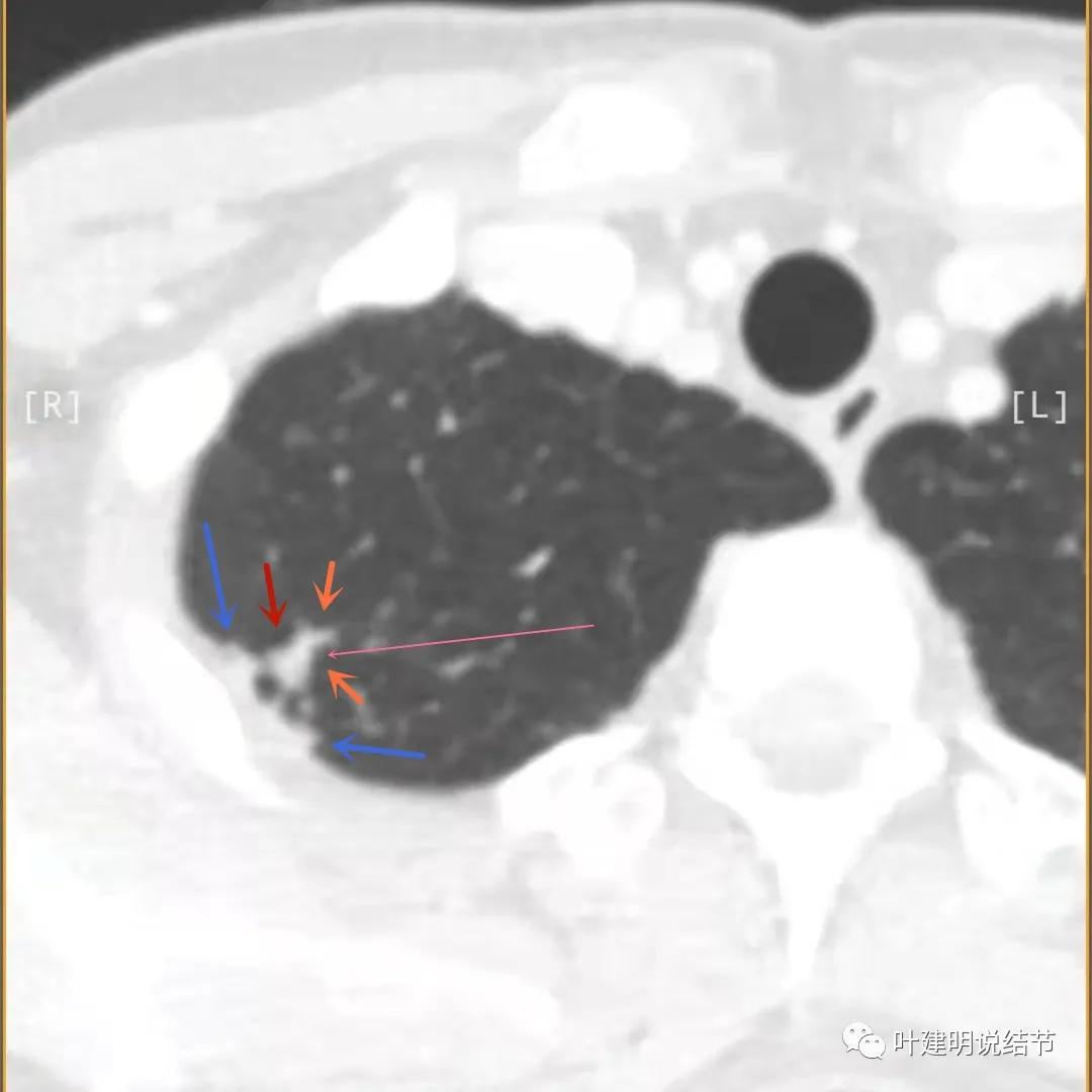 临床诊断孤立性肺结节,空洞型结节一般是什么性质