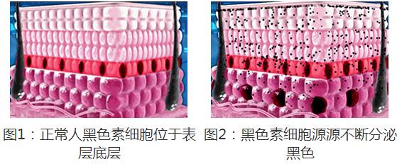 怎样辨别太田痣,婴儿太田痣扩散到几岁能稳定