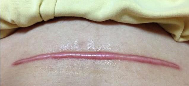 剖腹产不会导致松弛、漏尿、子宫脱垂？但这个危害很多女生不知道