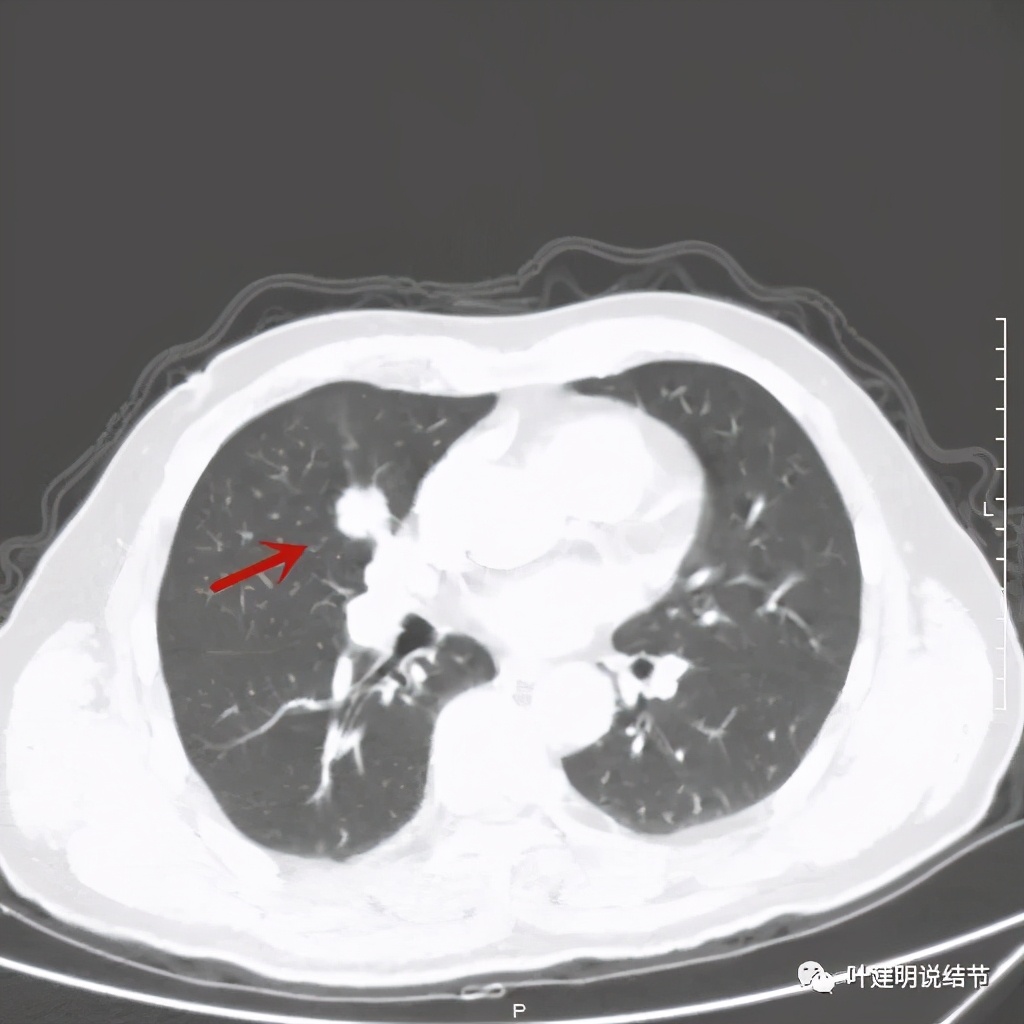实性结节影要不要紧,实性结节穿刺活检为良性
