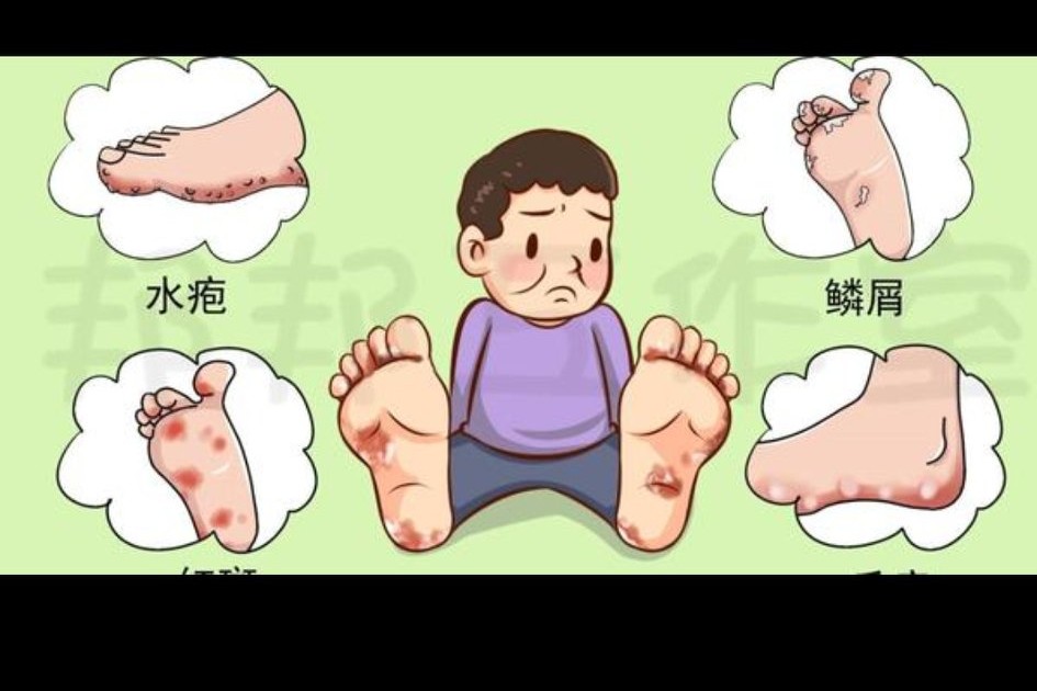 什么药治脚气超级有效,碘伏治脚气最好的方法