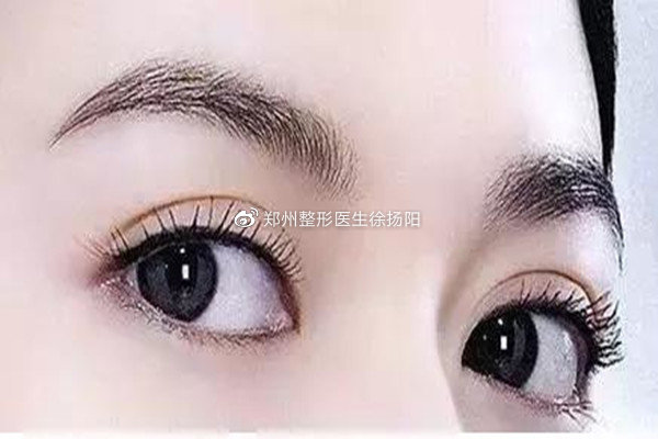 全切双眼皮吸脂和不吸脂的区别,哪些人不适合做吸脂术