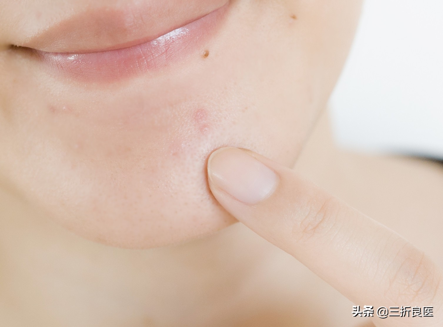 痘疤痘印怎么去除,光子嫩肤能去除痘印痘疤吗