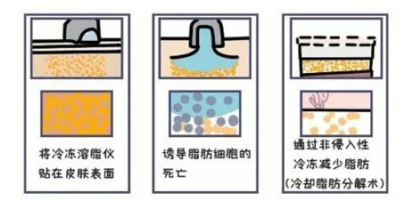 酷塑冷冻溶脂副作用是什么样的,酷塑冷冻溶脂的真实经历对比