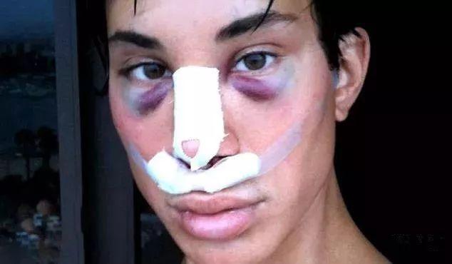 隆胸那些事你真的了解吗,隆胸加腹壁整形