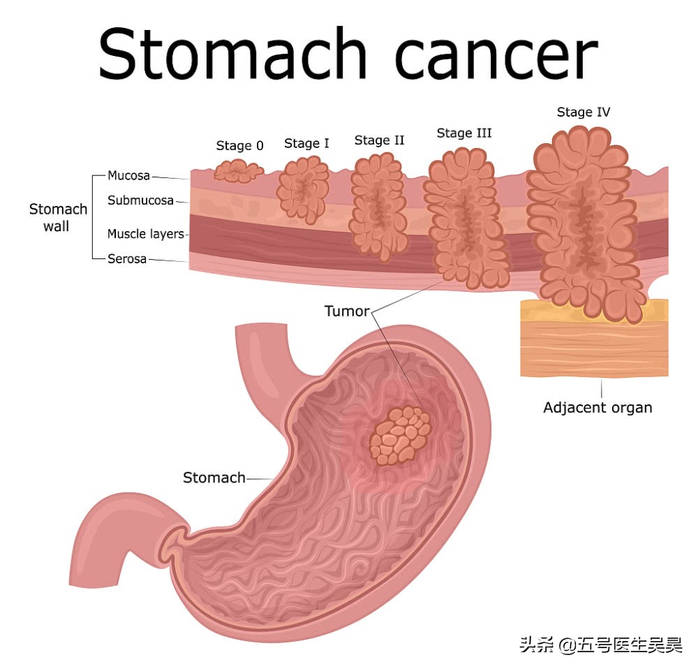 无痛胃镜检查后的注意事项有哪些,无痛胃镜肠镜陪同家属要注意什么