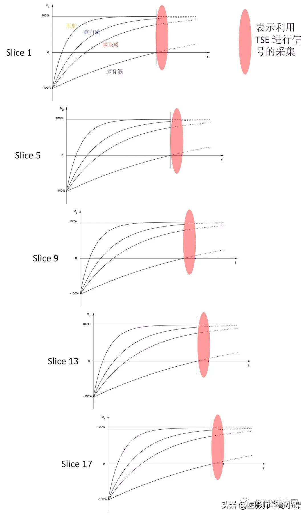 「MRI技术」磁共振伪影分析,了解下SSh_FLAIR序列