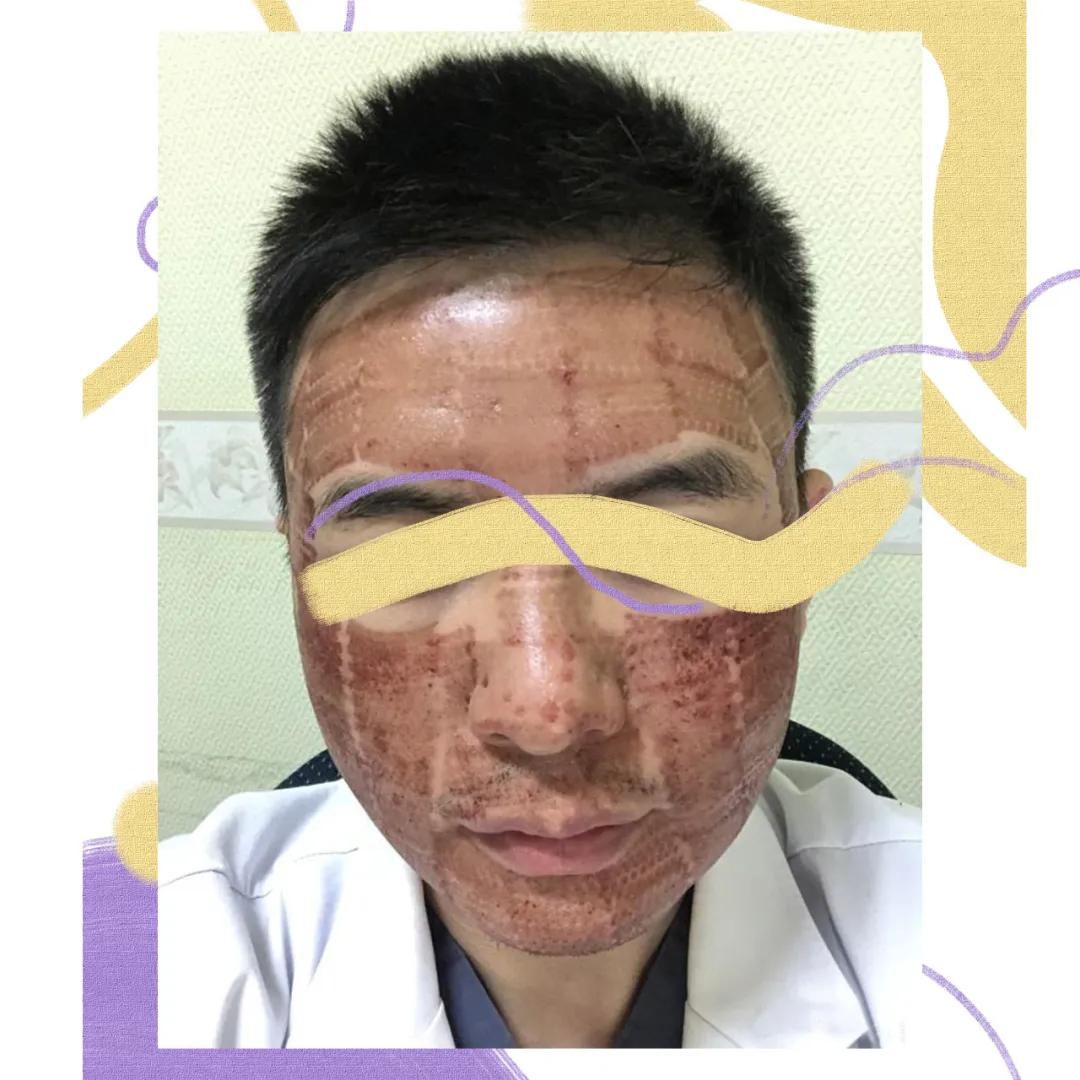 大痘印适合做什么医美,医美做什么可以去除痘坑