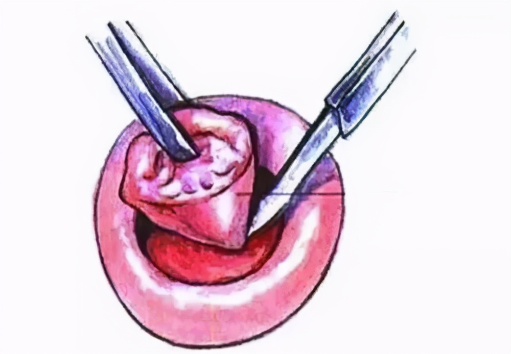宫颈癌前病变三级治疗费用多少,北京治疗宫颈癌前病变的老中医