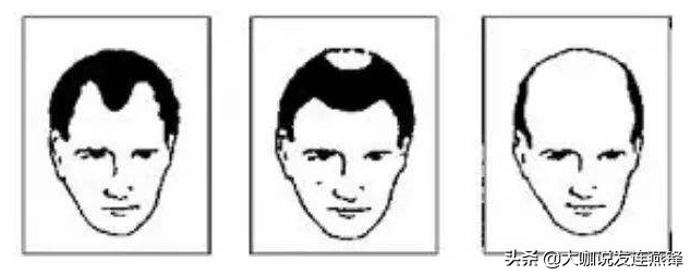 从后脑勺往头顶慢慢脱发,额前脱发植发效果如何