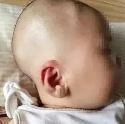 出生宝宝耳朵耳廓畸形判断,新生婴儿耳廓畸形圆耳