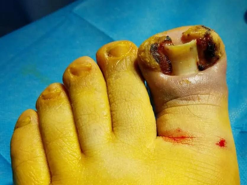 甲沟炎脚趾肿了要多久才能自愈,甲沟炎整个脚趾疼