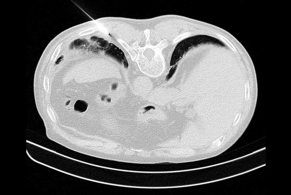 ct引导下穿刺活检诊断的分析,超声引导下穿刺活检什么样子的呢