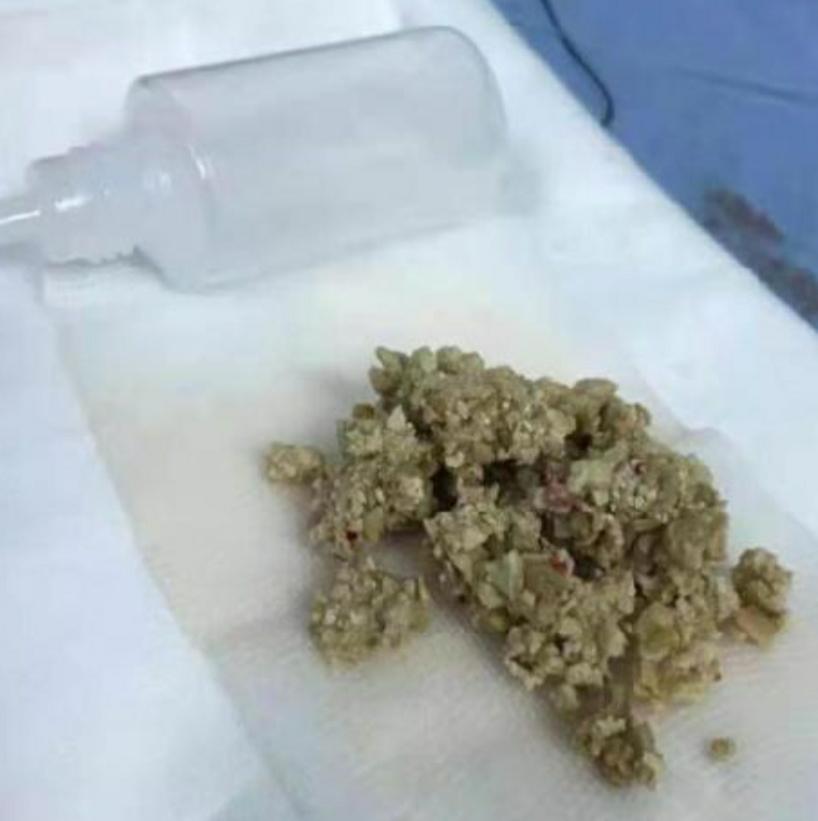 腰痛结石有哪些症状,腰痛结石