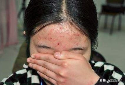 女生脸上长痘痘如何护肤,女生脸上长痘痘怎么食疗