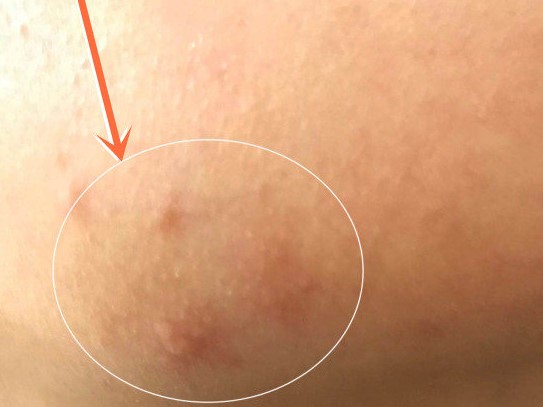 17岁的孩子身上脸上长了好多痘痘,17岁女孩脸上长好多痘痘怎么办