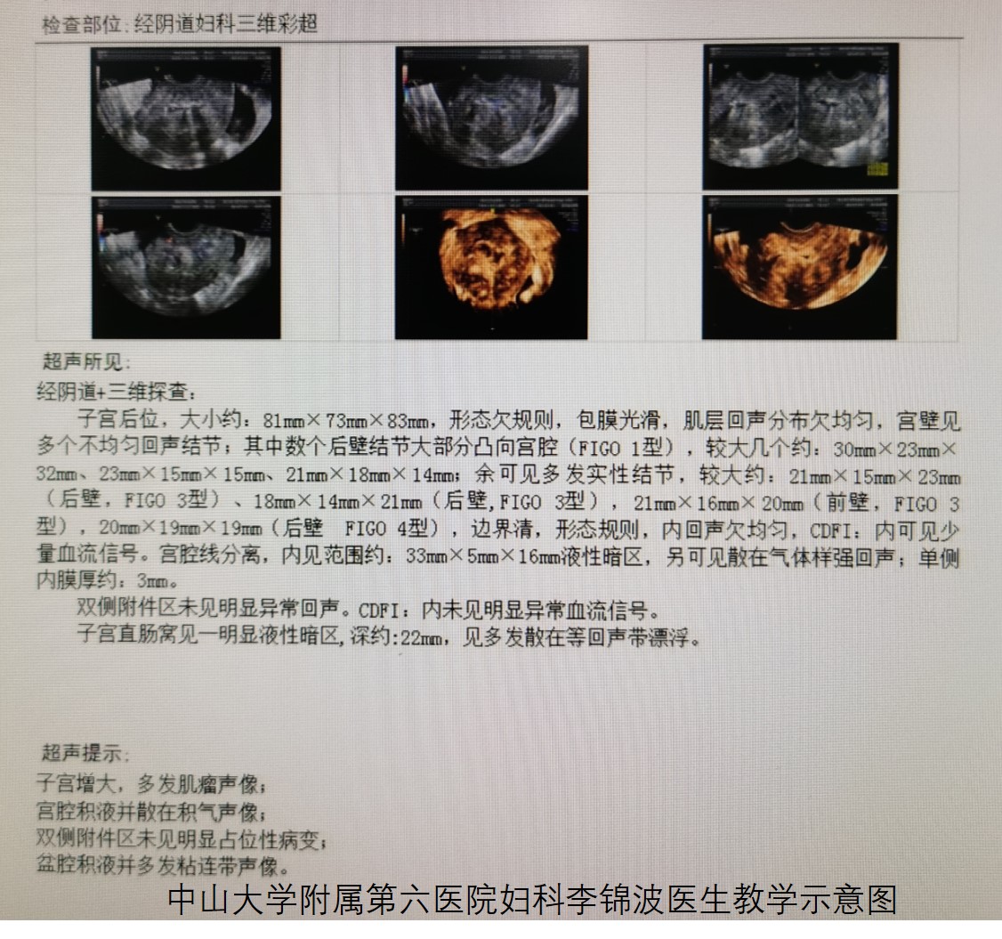 子宫肌瘤是不是必须做手术,子宫肌瘤做微创好还是手术开刀好