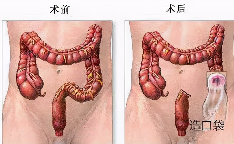 肠造口作用、位置、分类，一文秒懂