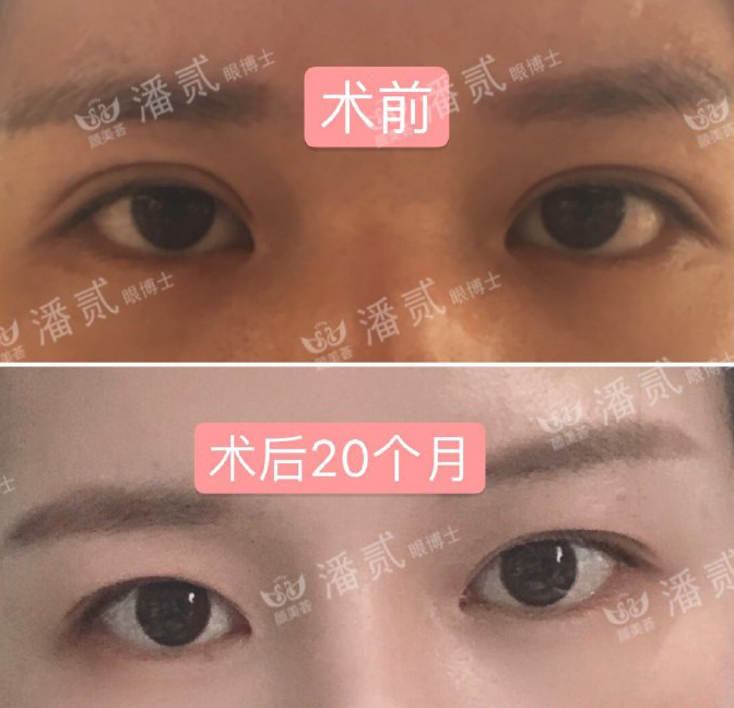 眼角下垂做双眼皮手术可以改变吗,后悔做双眼皮