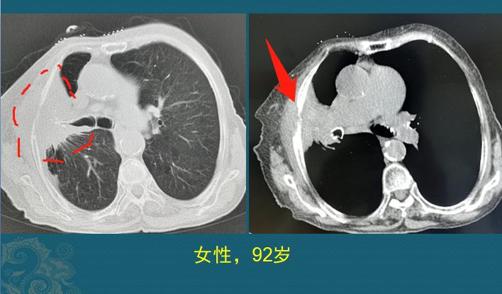 吃什么抗肺癌防癌最好,老年人肺癌晚期治疗成功案例