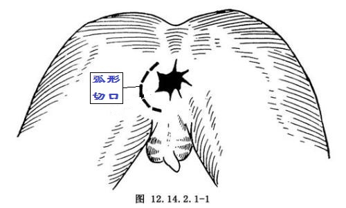 肛瘘lift手术天津哪有医院使用,北京哪家医院能做lift肛瘘手术