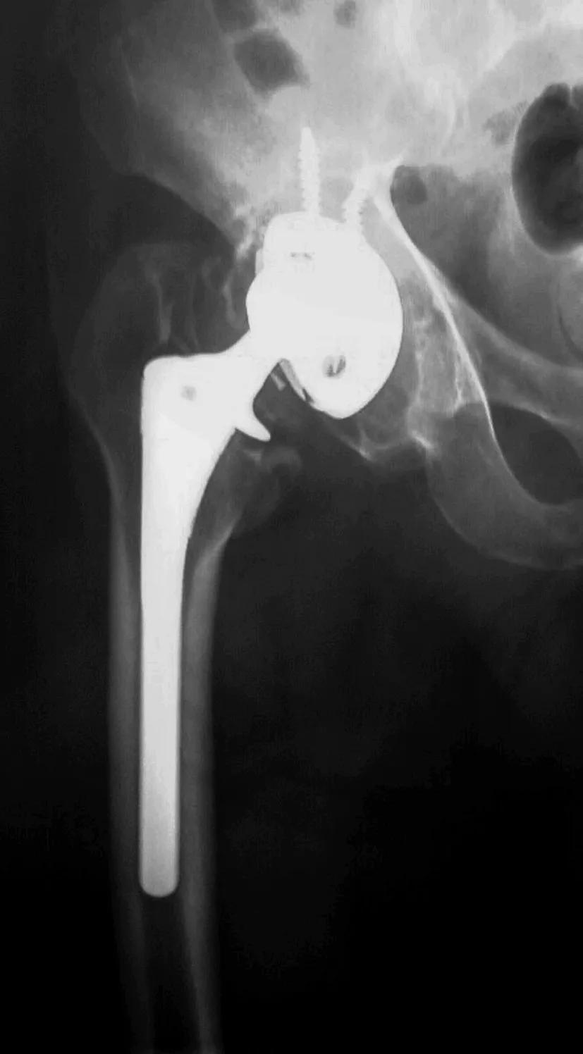 髋关节翻修术手术流程,人工髋关节翻修材料的选择