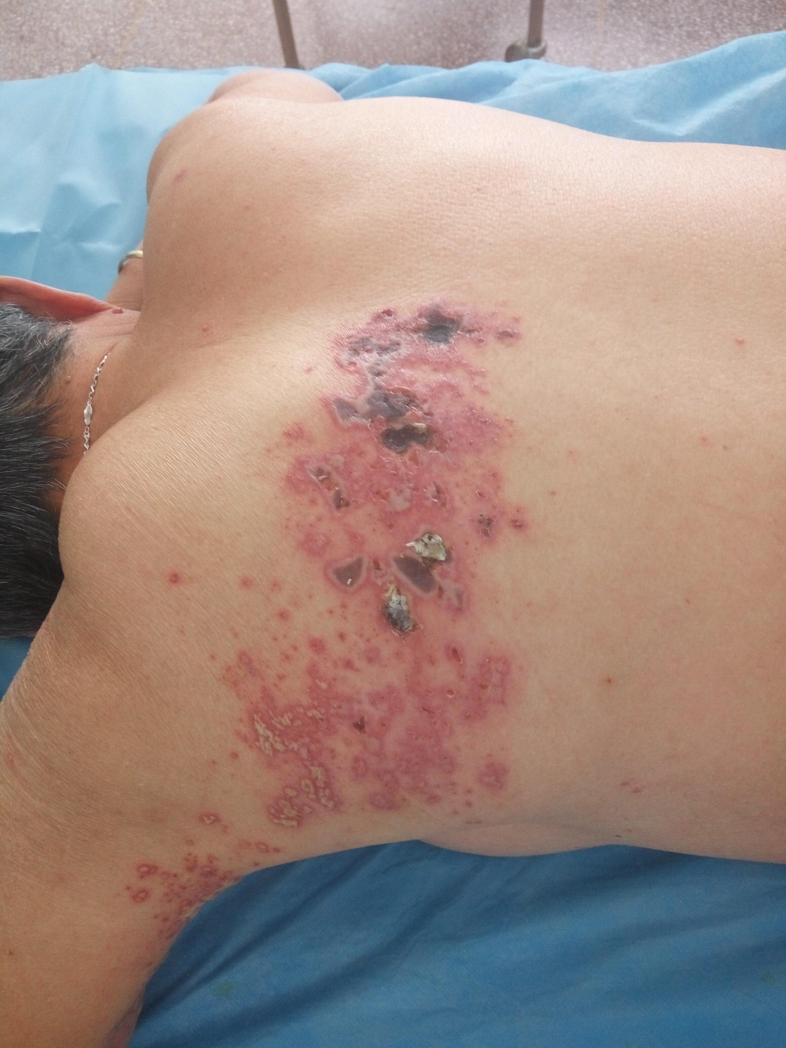 有没有最好的方法治疗带状疱疹,单纯疱疹与带状疱疹哪个难治