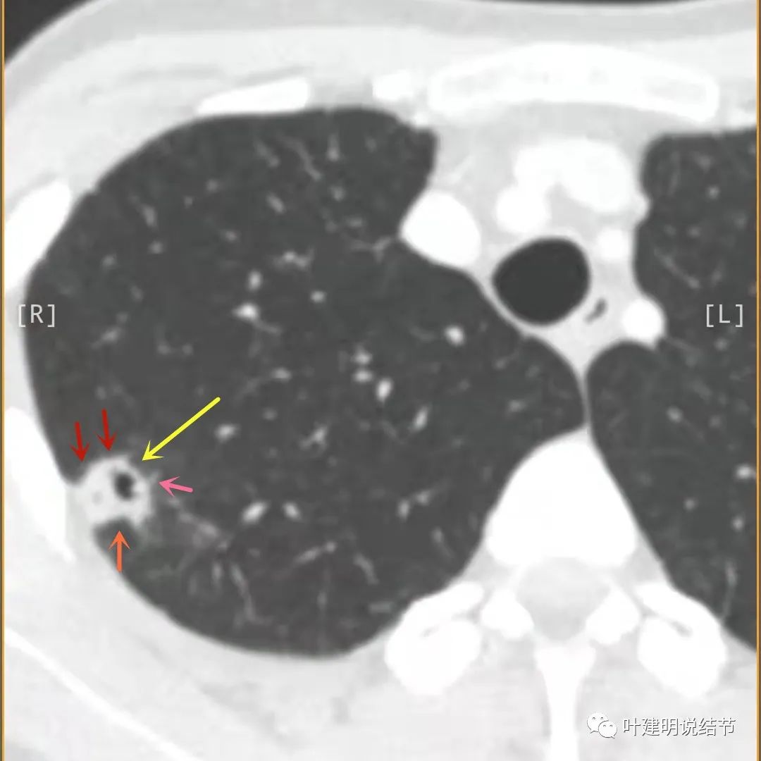 临床诊断孤立性肺结节,空洞型结节一般是什么性质